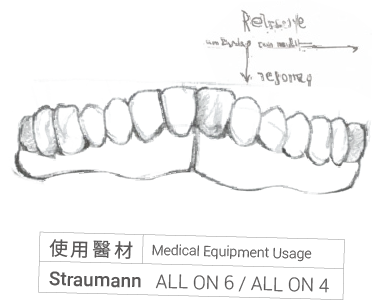 全口重建